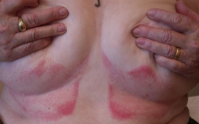 Skin folds can become uncomfortable fast.
