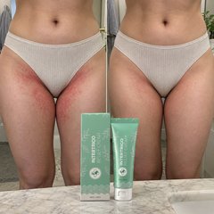 Kare Intertrigo Relief Cream™