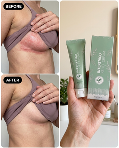 Kare Intertrigo Relief Cream™